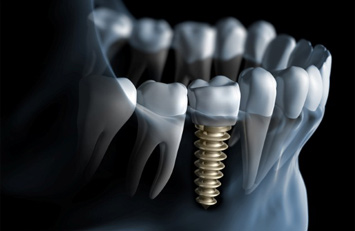 Zubni implantati | Zubna tehnika | Beograd