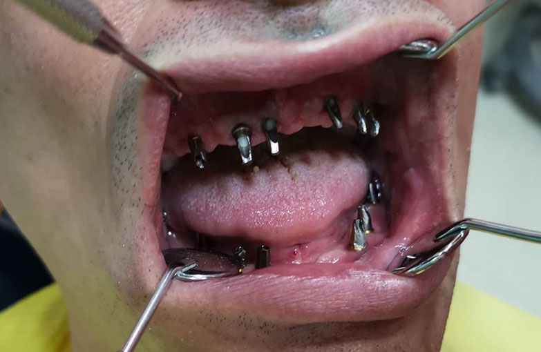 Zubna tehnika - Radovi na implantatima | Beograd