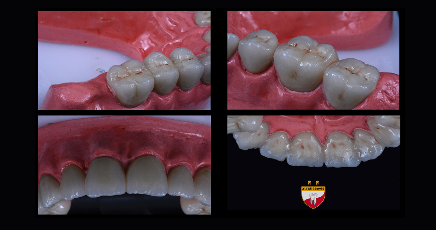 Zubna tehnika | Protetika | Metalo-keramički Mostovi | Beograd